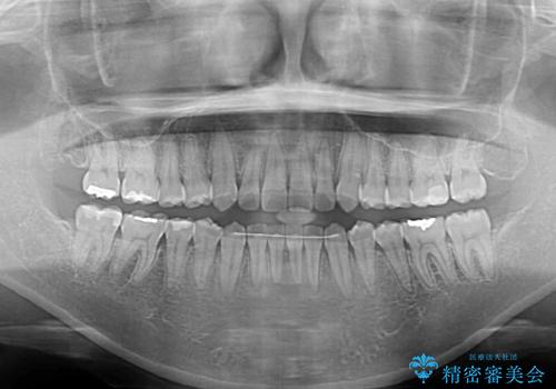 【モニター】カリエール・ディスタライザーを併用した八重歯のインビザライン矯正　の治療後