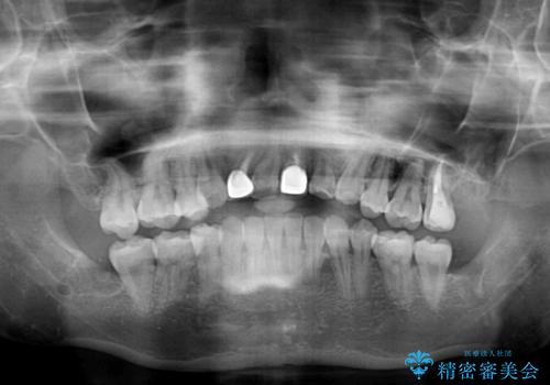 虫歯治療ついでに歯並びの後戻りを改善 インビザラインによる矯正治療の治療前