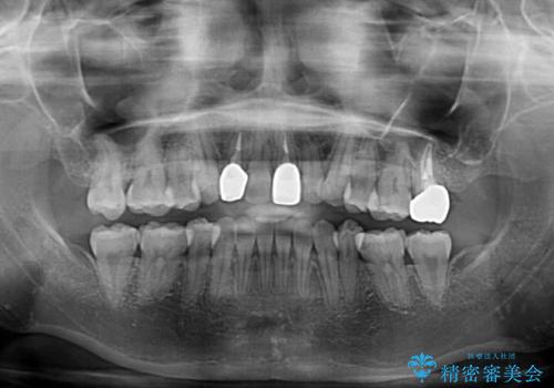 虫歯治療ついでに歯並びの後戻りを改善 インビザラインによる矯正治療の治療後