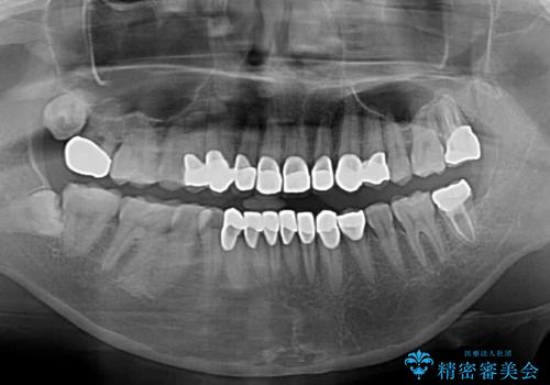 むし歯だらけの前歯をオールセラミッククラウンできれいにの治療後