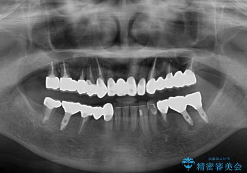 放置したインプラントとインビザライン 全顎リカバリー治療の治療後