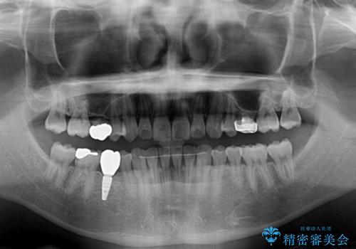 インビザラインによる矯正治療と奥歯のインプラント治療の治療後