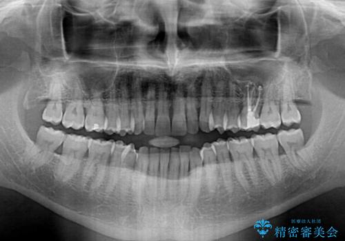 前歯でものを噛みきりたい　目立たない装置でのワイヤー矯正の治療前