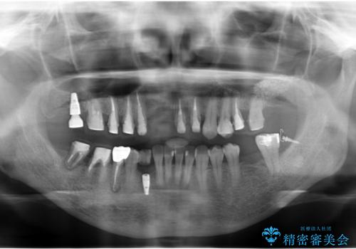 全体的な歯周病治療 包括治療の治療中