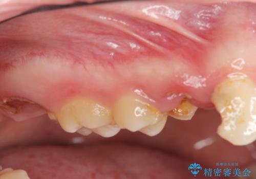 [ 歯肉縁下齲蝕 ]  歯周外科を行った虫歯治療の症例 治療前