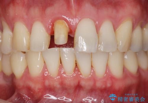 前歯の変色を改善!セラミック治療の治療中