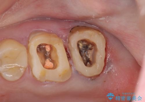 奥歯から臭いがする 銀歯下の虫歯再発の治療前