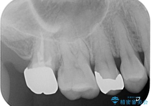 目立つ銀歯をセラミックに変えたい セラミックインレーの治療前