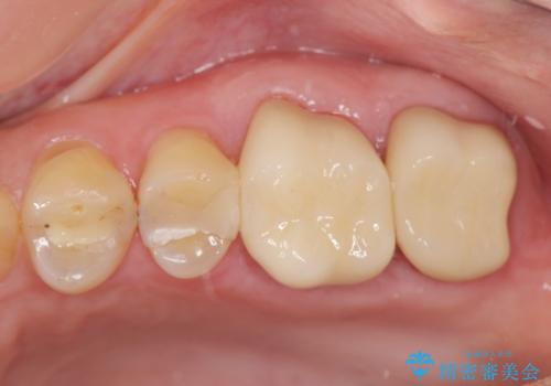 奥歯から臭いがする 銀歯下の虫歯再発の症例 治療後