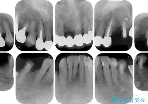 放置したインプラントとインビザライン 全顎リカバリー治療の治療前