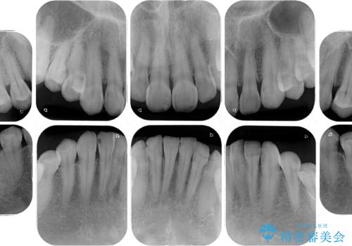 むし歯だらけの前歯をオールセラミッククラウンできれいにの治療前