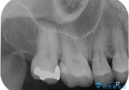 【セラミックインレー】昔治療した詰め物が外れた。の治療前