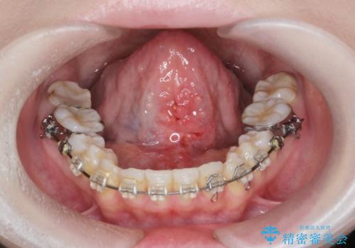 滑舌を改善!　舌小帯の形成術の治療後