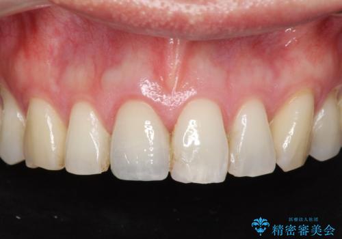 前歯の変色を改善!セラミック治療の治療後