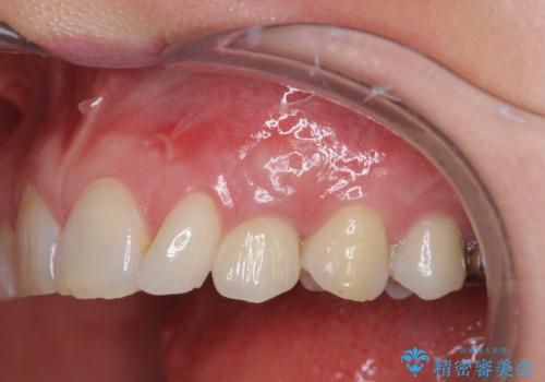 骨造成を伴う 前歯部インプラント治療の症例 治療後