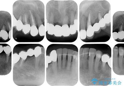 放置したインプラントとインビザライン 全顎リカバリー治療の治療後