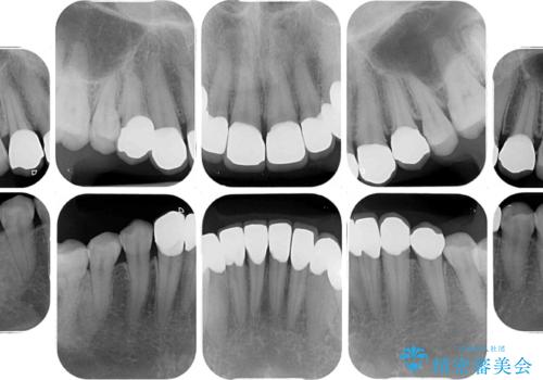 むし歯だらけの前歯をオールセラミッククラウンできれいにの治療後