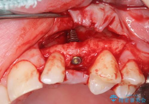 骨造成を伴う 前歯部インプラント治療の治療中