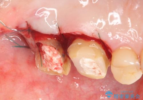 奥歯から臭いがする　銀歯下の虫歯再発の治療中