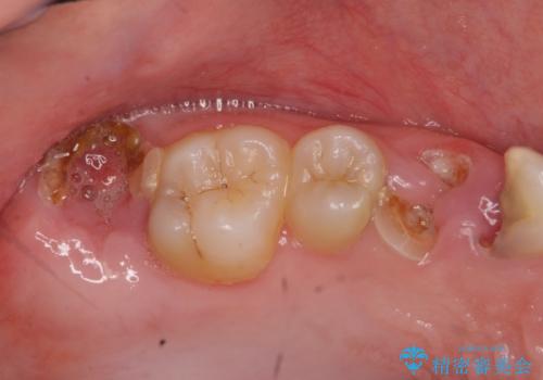 [ 歯肉縁下齲蝕 ]  歯周外科を行った虫歯治療の治療前