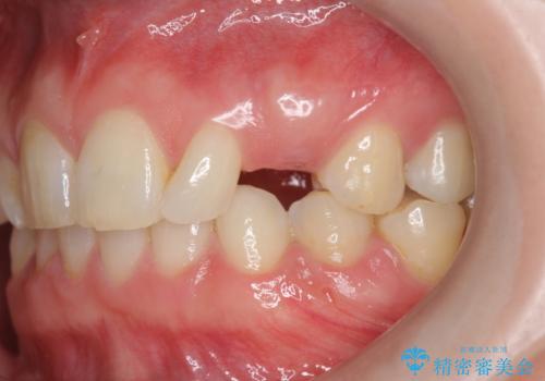 骨造成を伴う 前歯部インプラント治療の治療前