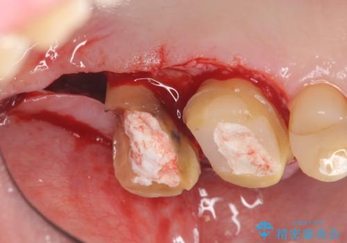 奥歯から臭いがする 銀歯下の虫歯再発の治療中