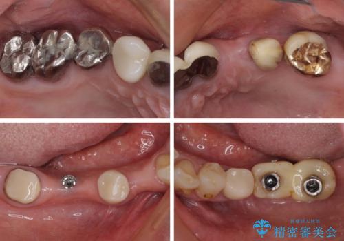 放置したインプラントとインビザライン 全顎リカバリー治療の治療前