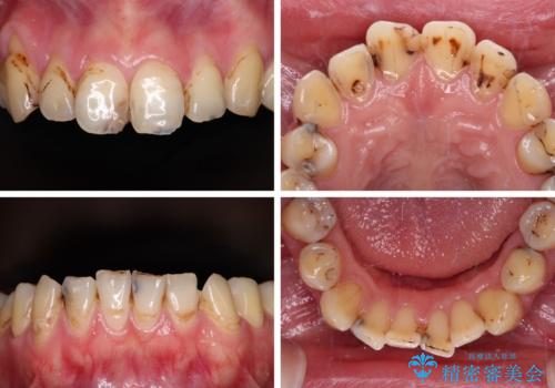 むし歯だらけの前歯をオールセラミッククラウンできれいにの治療前