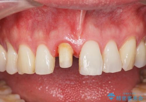 前歯の変色を改善!セラミック治療の治療中