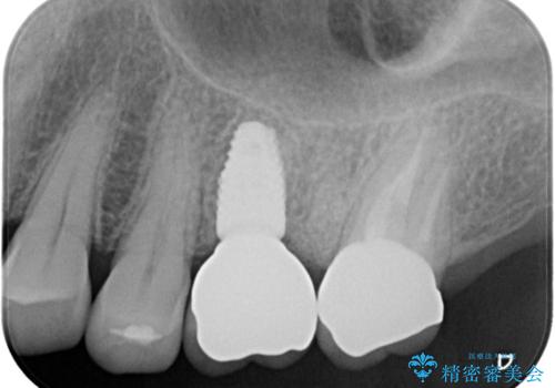 【歯牙破折】インプラントによる咬合回復の治療後