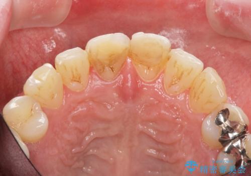 前歯の変色を改善!セラミック治療の治療前