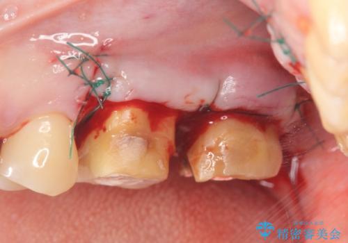 奥歯から臭いがする 銀歯下の虫歯再発の治療中