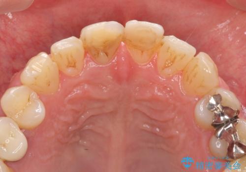 前歯の変色を改善!セラミック治療の治療前