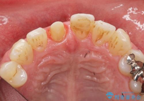 前歯の変色を改善!セラミック治療の治療中