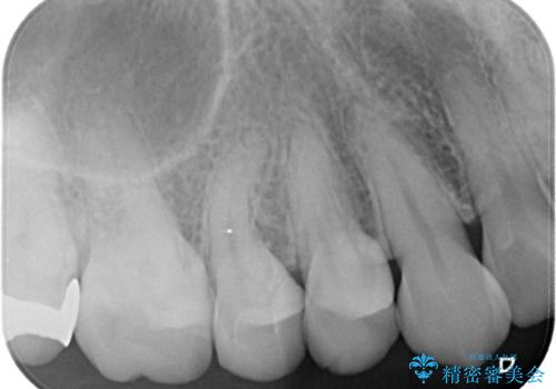 【セラミックインレー】昔治療した詰め物が外れた。の治療後