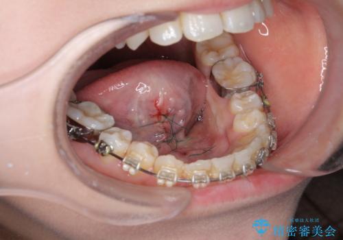 滑舌を改善! 舌小帯の形成術の治療中