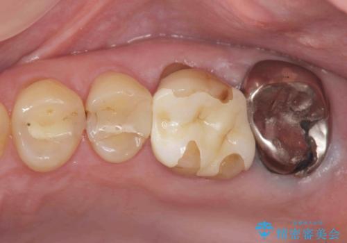 奥歯から臭いがする 銀歯下の虫歯再発の症例 治療前