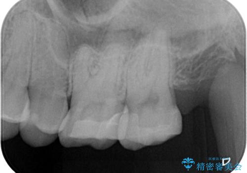 【セラミックインレー】適合の良いセラミックインレーを入れたい。の治療後