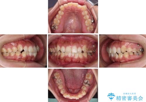 【モニター】カリエール・ディスタライザーを併用した八重歯のインビザライン矯正 の治療中