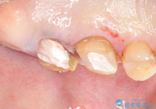奥歯から臭いがする 銀歯下の虫歯再発の治療中