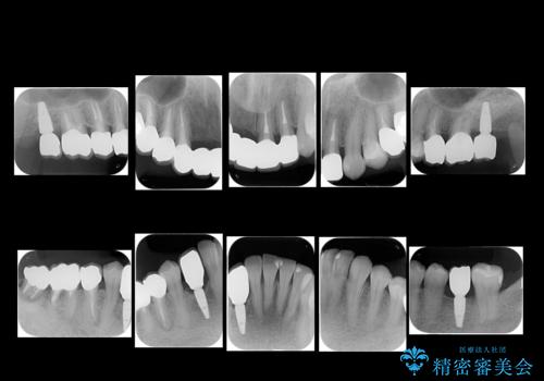 全体的な歯周病治療 包括治療の治療後