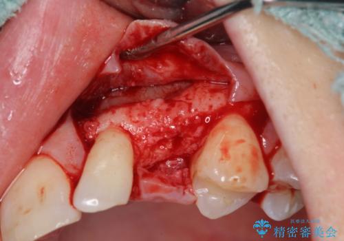 骨造成を伴う 前歯部インプラント治療の治療中