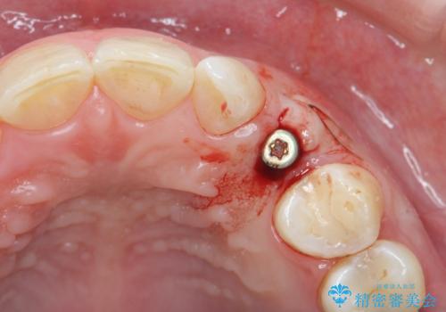 骨造成を伴う 前歯部インプラント治療の治療中