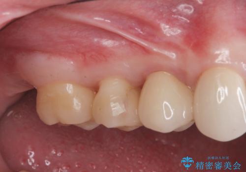 [ 歯肉縁下齲蝕 ]  歯周外科を行った虫歯治療の治療後