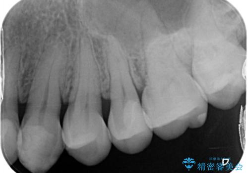 矯正後セラミックインレーにしたいの治療後