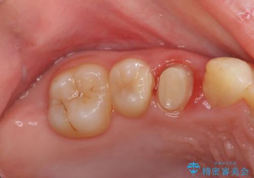 [ 歯肉縁下齲蝕 ]  歯周外科を行った虫歯治療の治療中