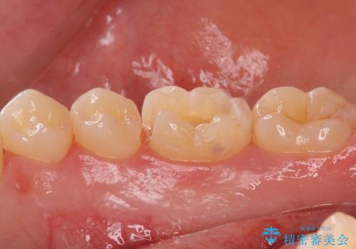 矯正後の虫歯治療 セラミックインレーでの治療の治療中