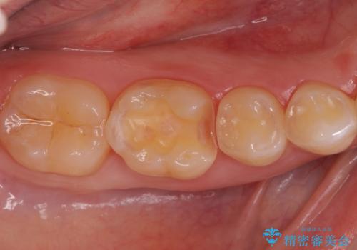 矯正後の虫歯治療 セラミックインレーでの治療の治療中