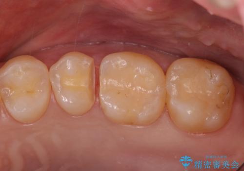 歯と歯の間の虫歯 セラミックインレーでの治療の治療中