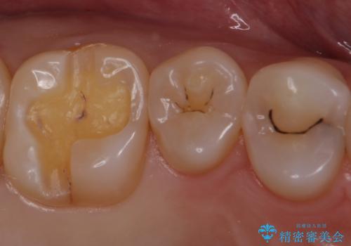 銀歯を白くしたい セラミックインレーでの治療の治療中